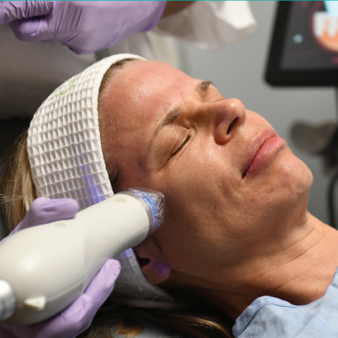 Secret Rf Micro Needling Skin Tightening Aislinn Medical Spa