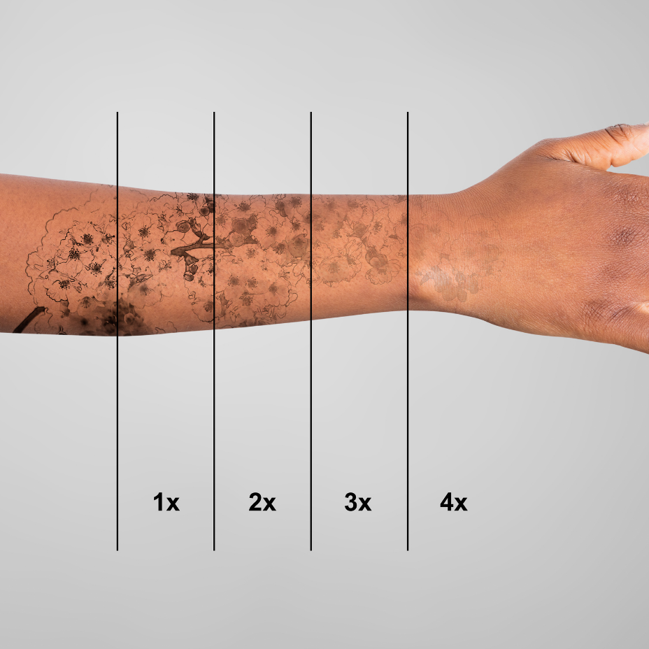 Saline Tattoo Removal  One of the Best PMU removal Methods