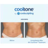 Cooltone by Coolsculpting